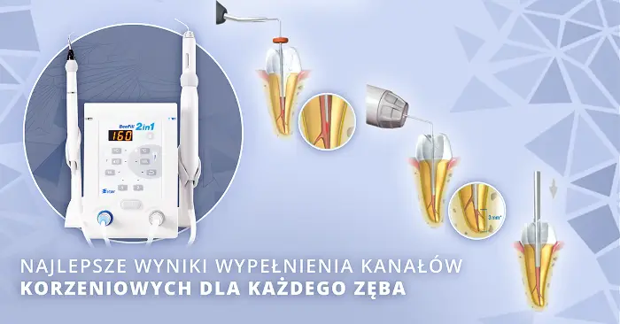 leczenie kanałowe -ile trwa