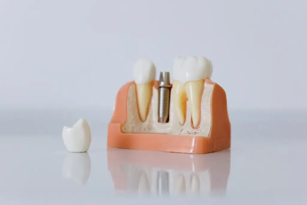 Model dentystyczny przedstawiający dwa naturalne zęby i implant zęba z metalową śrubą między nimi, ze sztucznym zębem leżącym osobno po lewej stronie, wszystko na odblaskowej powierzchni.