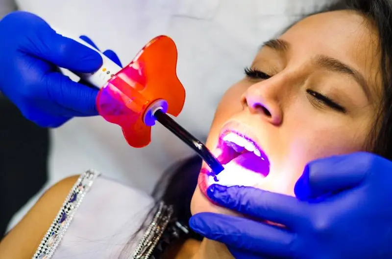 Dentysta w niebieskich rękawiczkach używa urządzenia do utwardzania światła wewnątrz otwartych ust kobiety podczas zabiegu dentystycznego. Pacjentka, stosująca białą dietę, leży z szeroko otwartymi ustami, podczas gdy światło świeci jasno.